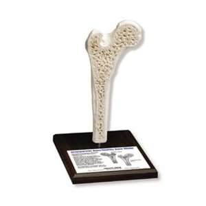  Osteoporotic Bone/Healthy Bone Model