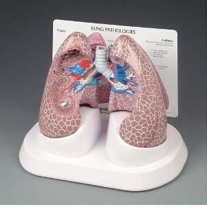  Diseased Lung Model G311